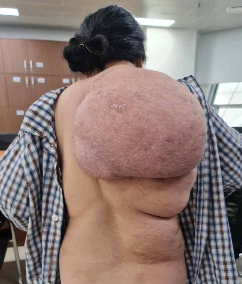 Người phụ nữ mang khối u khổng lồ trên vai như mai rùa - 1