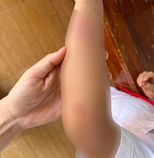 Cháu bé 9 tuổi bị bà và cha đánh đập dã man