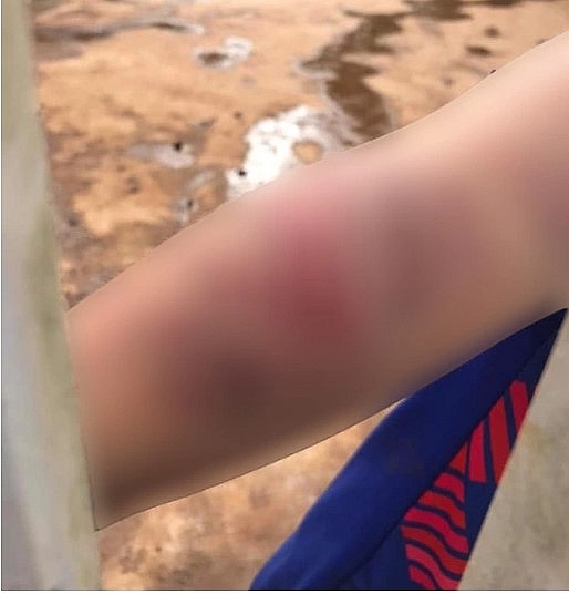 Cháu bé 9 tuổi bị bà và cha đánh đập dã man