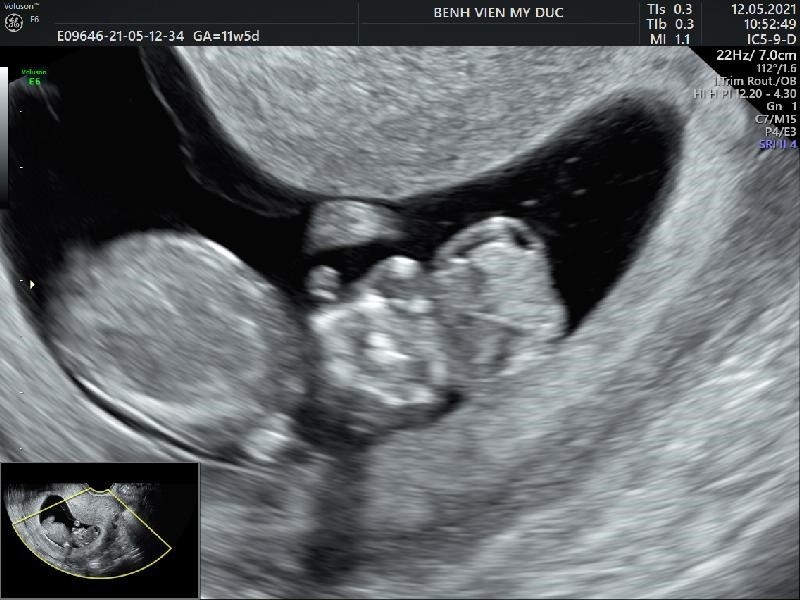 ULTRASOUND SCREENING AND DIAGNOSIS OF FETAL ABNOMALIES