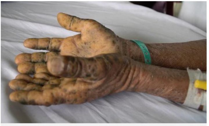 Uống thuốc tăng cường sinh lý, nào ngờ nhiễm độc toàn thân