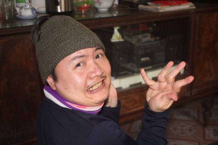 Anh Phan Hoàng Dương, xã Mỹ Tân, huyện Mỹ Lộc, tỉnh Nam Định bị dị dạng, dị tật là sự thật