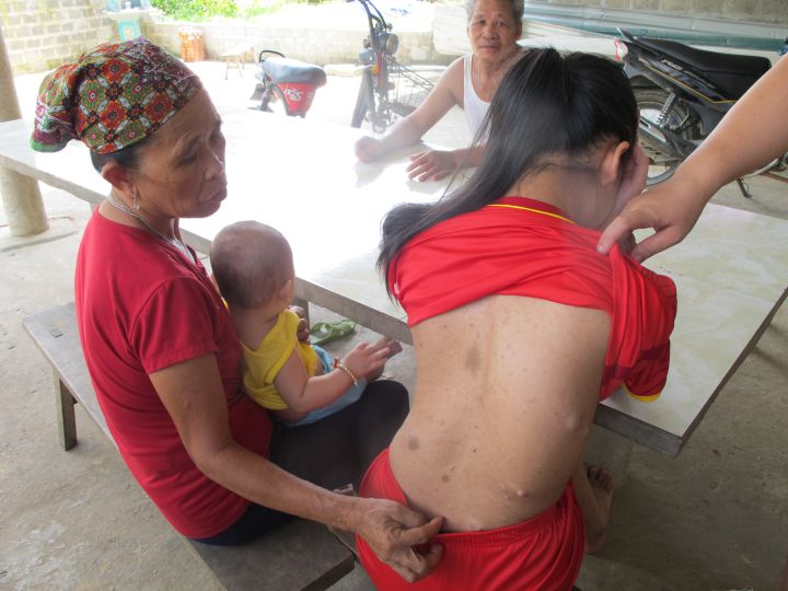 Ứớc nguyện của một Thương binh nạn nhân chất độc da cam