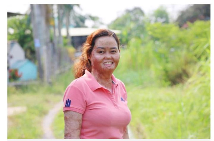 Người phụ nữ bị chồng tưới xăng thiêu sống, bỏng 92% hiện nay sống ra sao