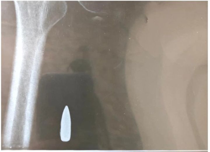 Lấy thành công đầu đạn nằm 54 năm trong người bệnh nhân