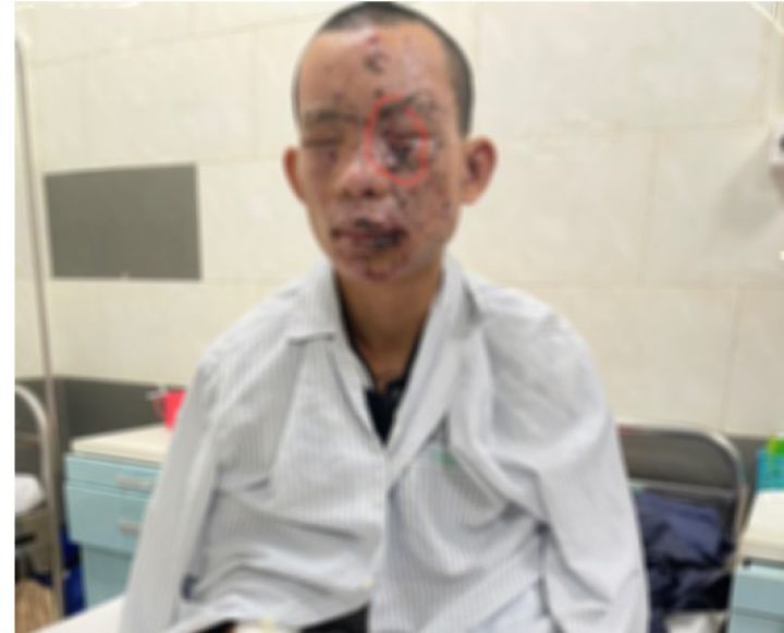 Nam thanh niên bị cháy sém toàn thân