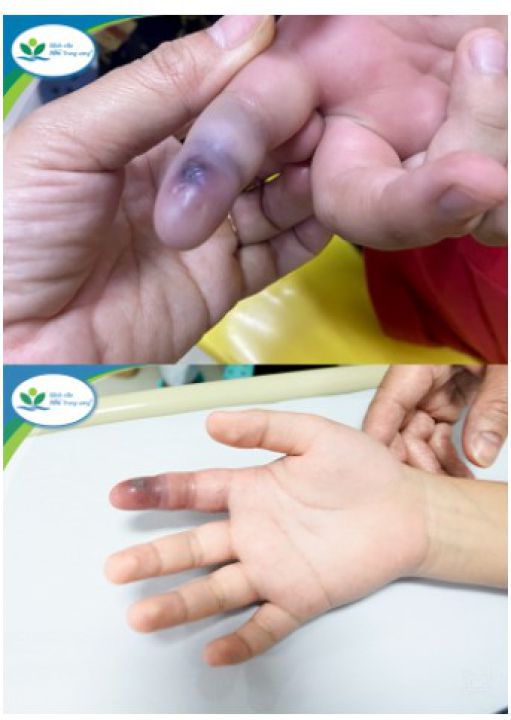 Hà Nội: Lén nuôi rắn lục đuôi đỏ làm thú cưng, bé trai 13 tuổi bị cắn nguy hiểm tính mạng