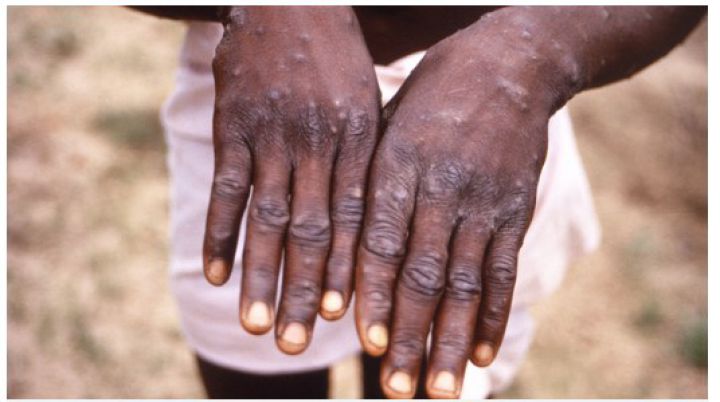 Chuyên gia: "Đậu mùa khỉ khó có thể lây lan thành đại dịch"