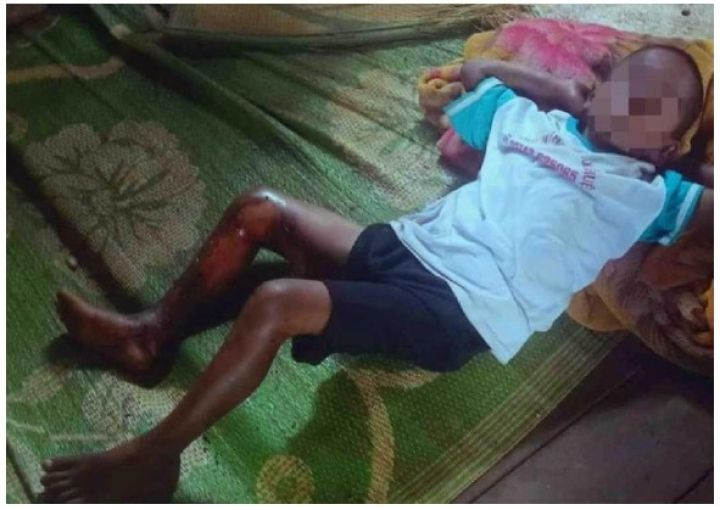 Điều tra nghi án bé trai bị tẩm xăng đốt hai chân vì không chịu đi trộm trái cây