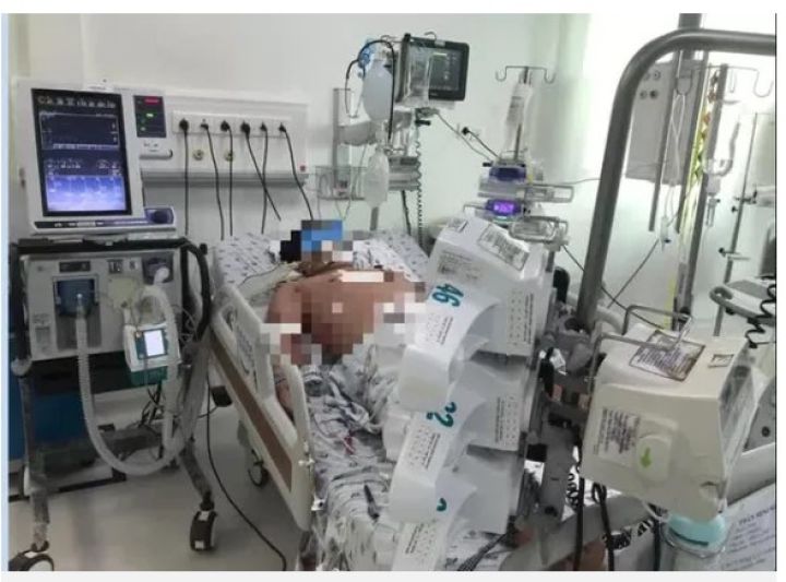 Hàng loạt trẻ thừa cân béo phì sốc sốt xuất huyết nặng