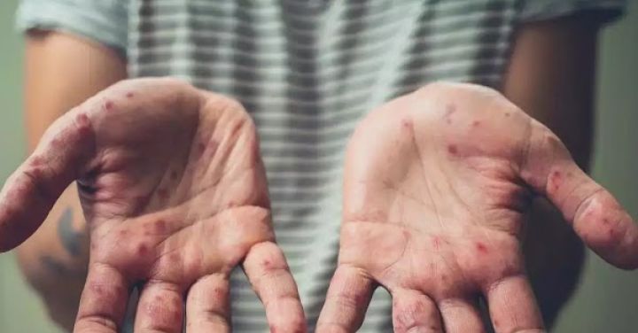 Nóng: Nguy cơ bệnh đậu mùa khỉ xâm nhập Việt Nam, Bộ Y tế họp khẩn