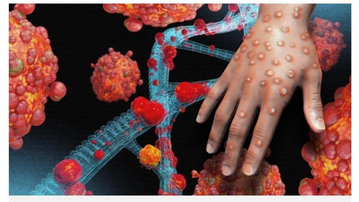 Bệnh đậu mùa khỉ: Ai dễ nhiễm và dễ bị bệnh nặng?