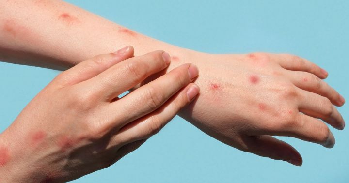 Triệu chứng của bệnh đậu mùa khỉ đang thay đổi