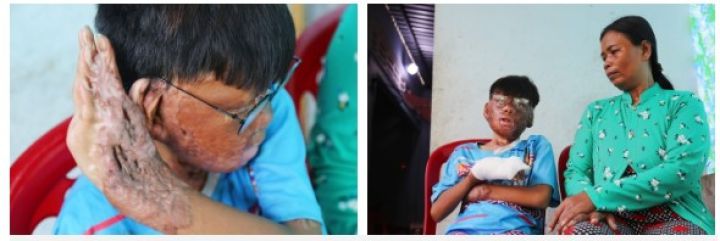 Mùa Vu Lan về thăm cậu bé bị bỏng 96% khi liều mình quay lại cứu mẹ nuôi trong căn nhà bốc cháy: 