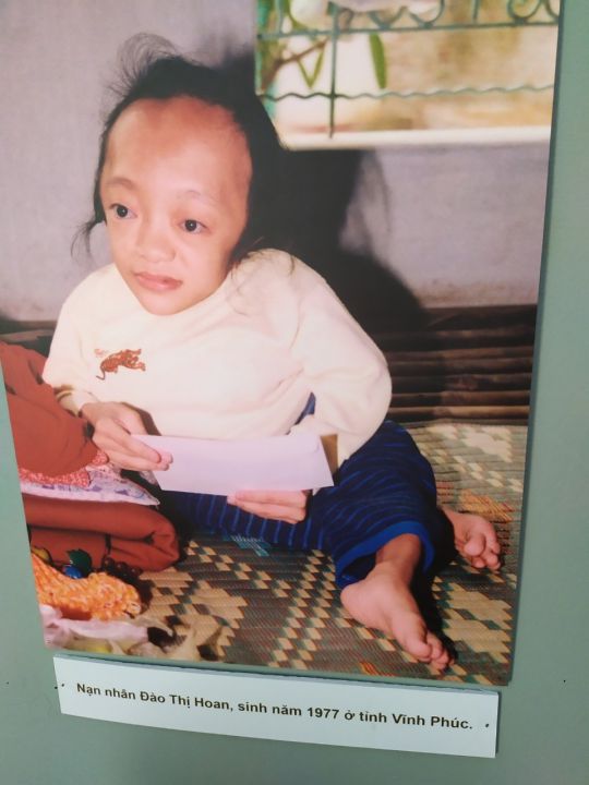 CÁC BỆNH TẬT LIÊN QUAN ĐẾN VIỆC TIẾP XÚC VỚI CHẤT DA CAM /DIOXIN TẠI VIỆT NAM Ở CÁC CỰU CHIẾN BINH MỸ