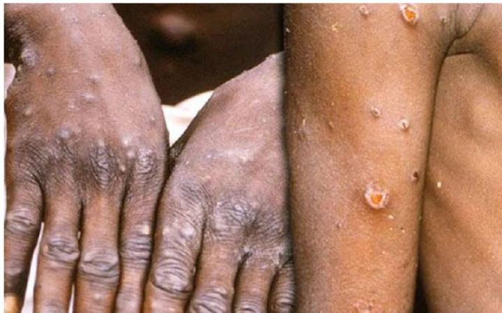 Đậu mùa khỉ xuất hiện tại Việt Nam: Chuyên gia phân tích và chỉ cách phòng ngừa