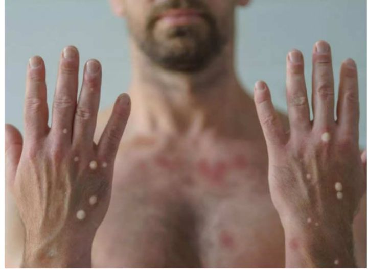 Ai có nguy cơ cao mắc bệnh đậu mùa khỉ?